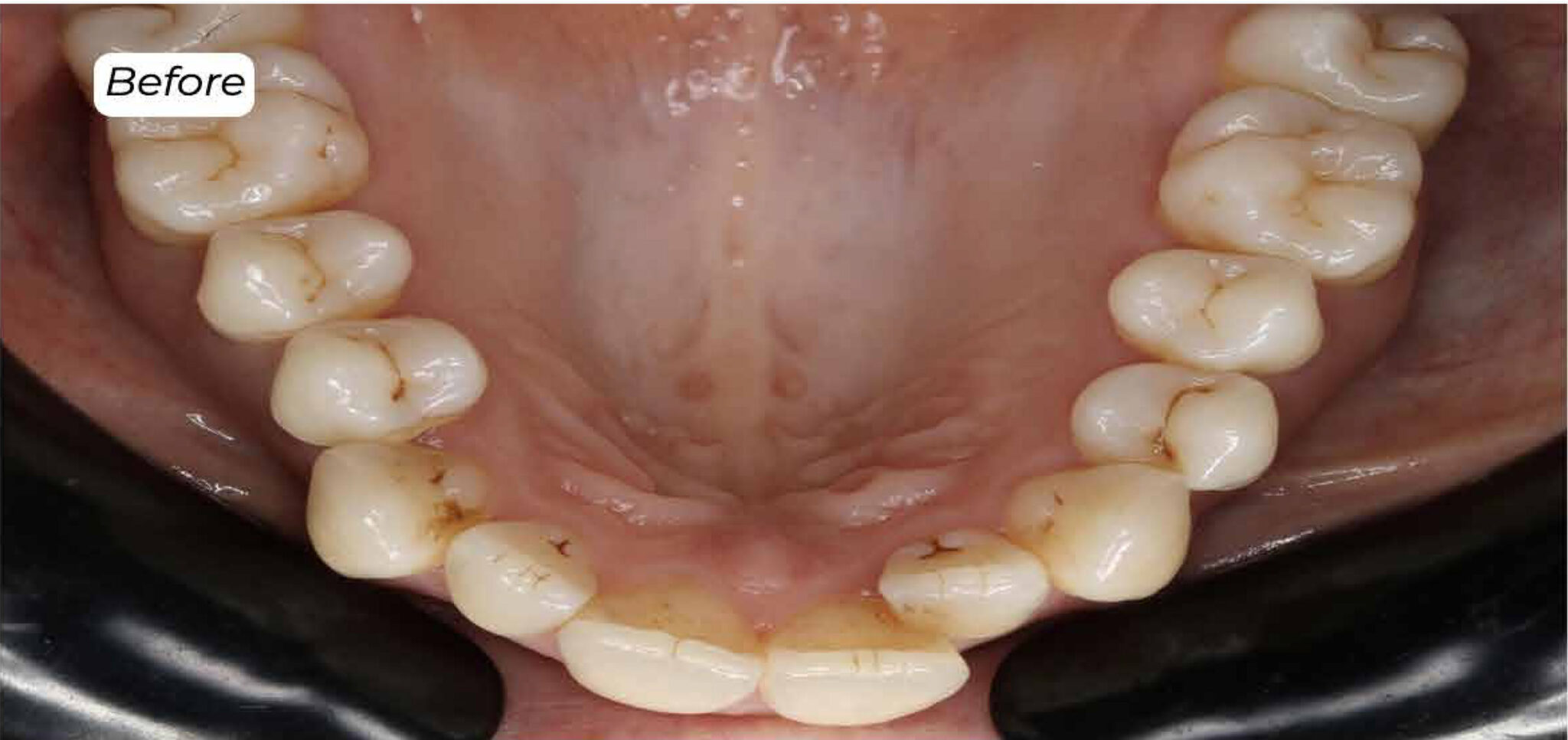 Invisalign Holly House Dental Practice